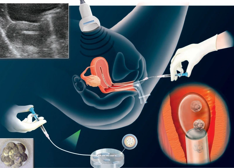 chuyen-phoi-ivf-thai-lan