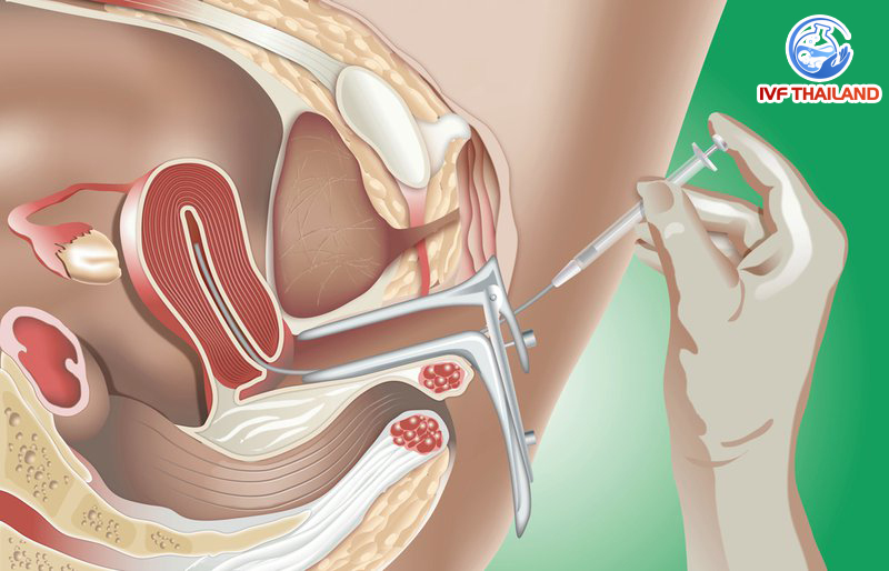 iui tai Thailand