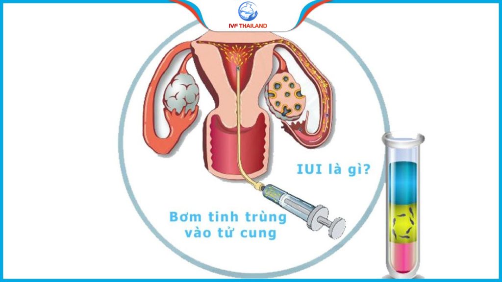 thu-tinh-nhan-tao-iui