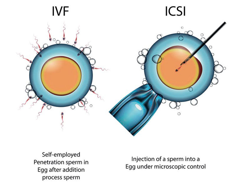 Sự khác biệt giữa IVF và ICSI là gì?