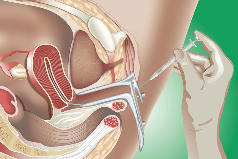 “Thời điểm vàng” thực hiện phương pháp thụ tinh nhân tạo IUI