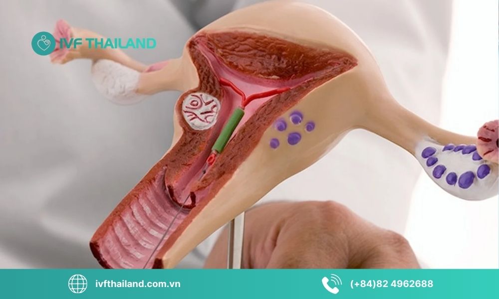 Lời khuyên từ chuyên gia khi AMH thấp